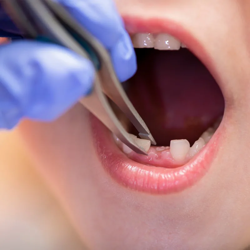 Pediatric Tooth Extraction in Fremont, CA