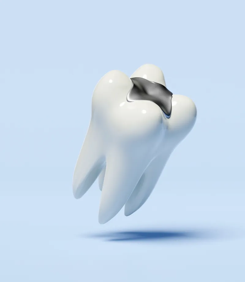 What Are Tooth Fracturess